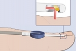 lightneedle-diagram